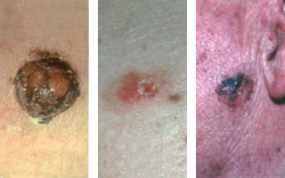 skincancer